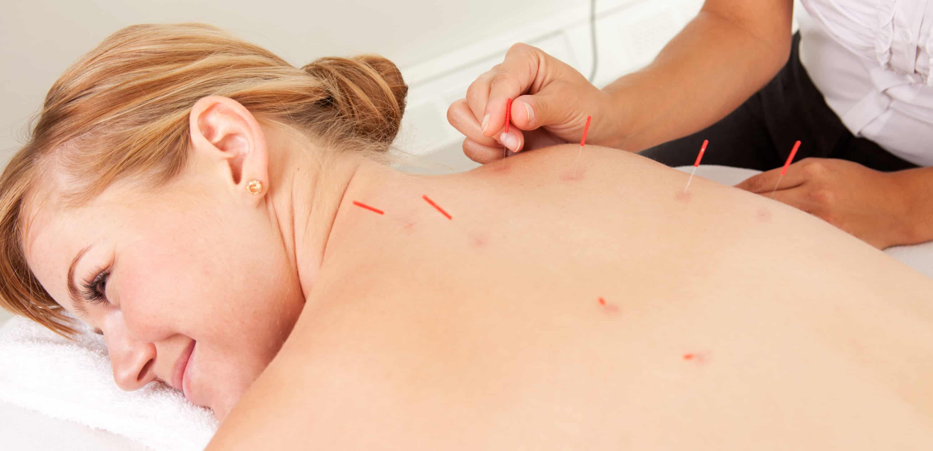 Was sind Akupunkturärzte?